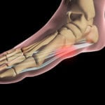 What is Plantar Fasciitis and How Do I Treat It?