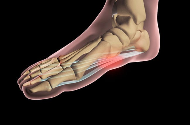 What is Plantar Fasciitis and How Do I Treat It?