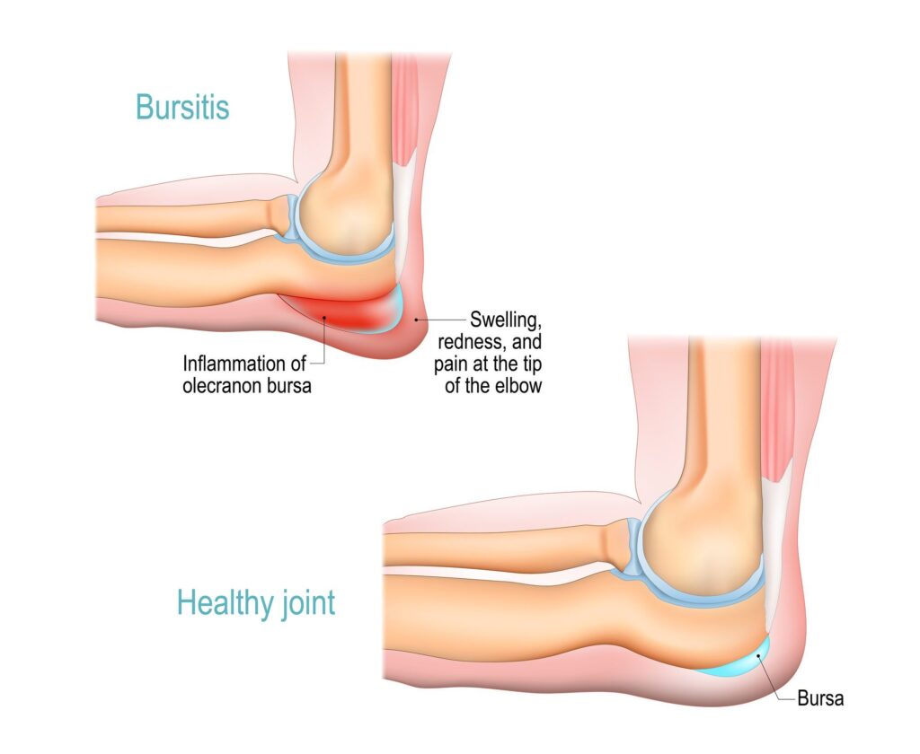 Olecranon bursitis illustration of inflamed student's elbow