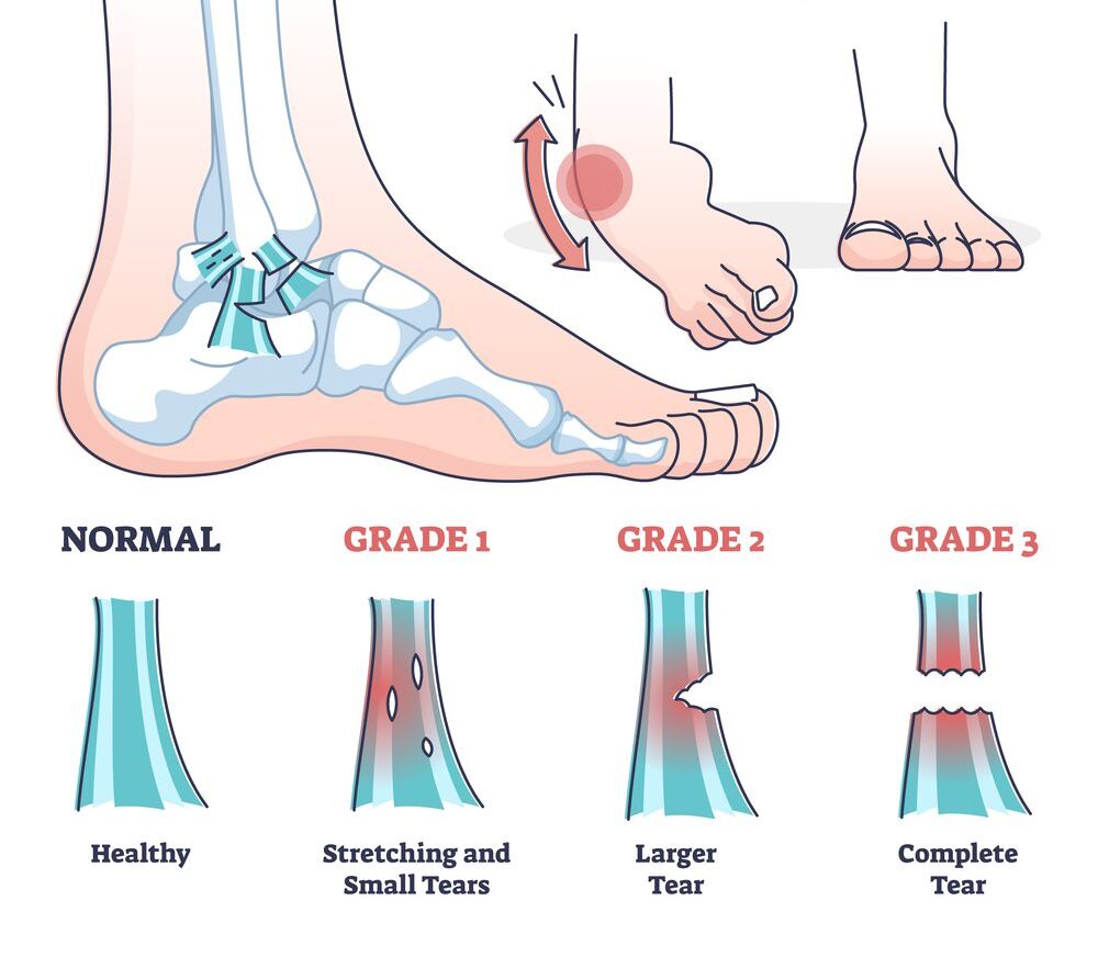 Grades of sprain as ankle or foot medical injury levels outline diagram