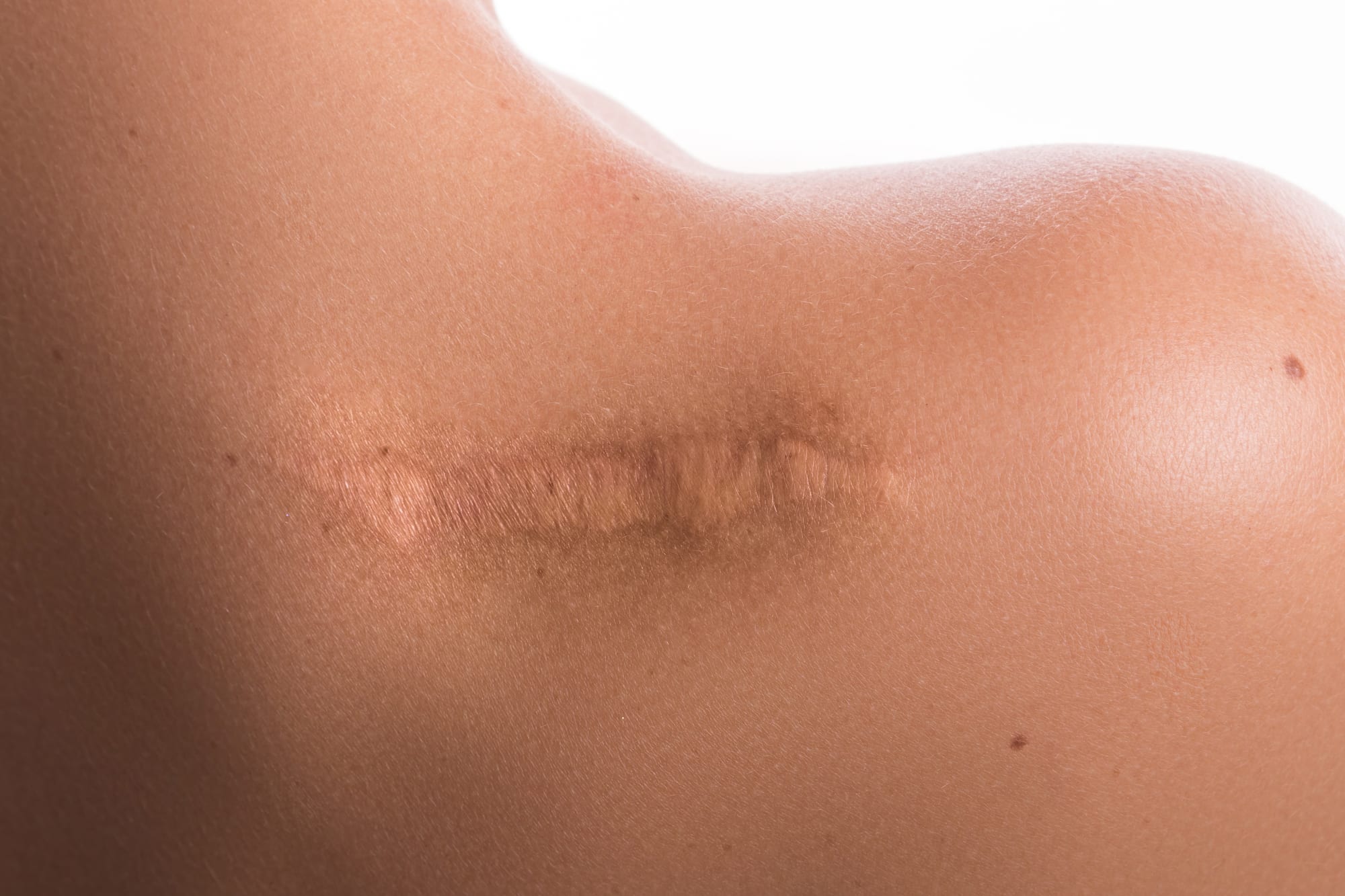 Scar tissue: Causes, prevention, and treatment